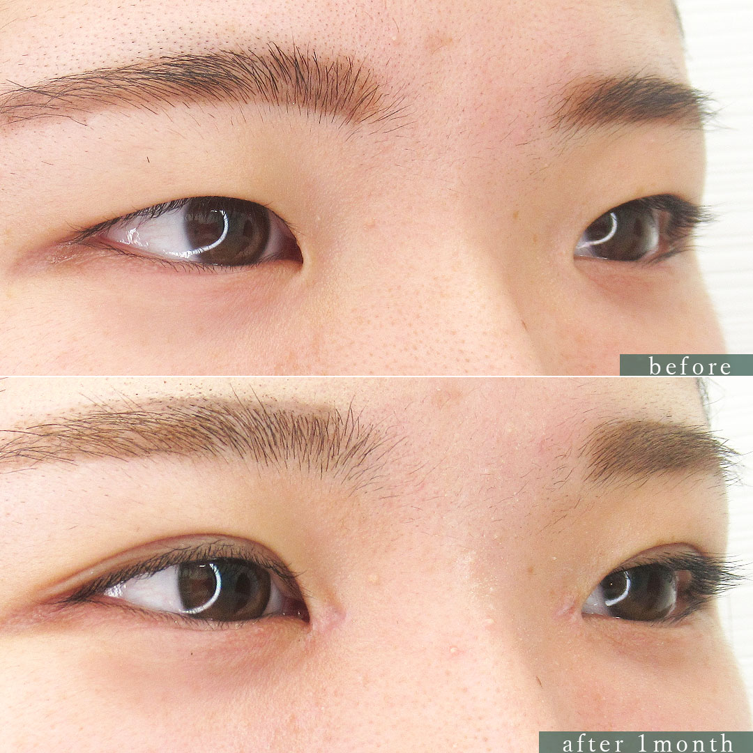 二重埋没法/目頭切開術の症例写真 施術前後 