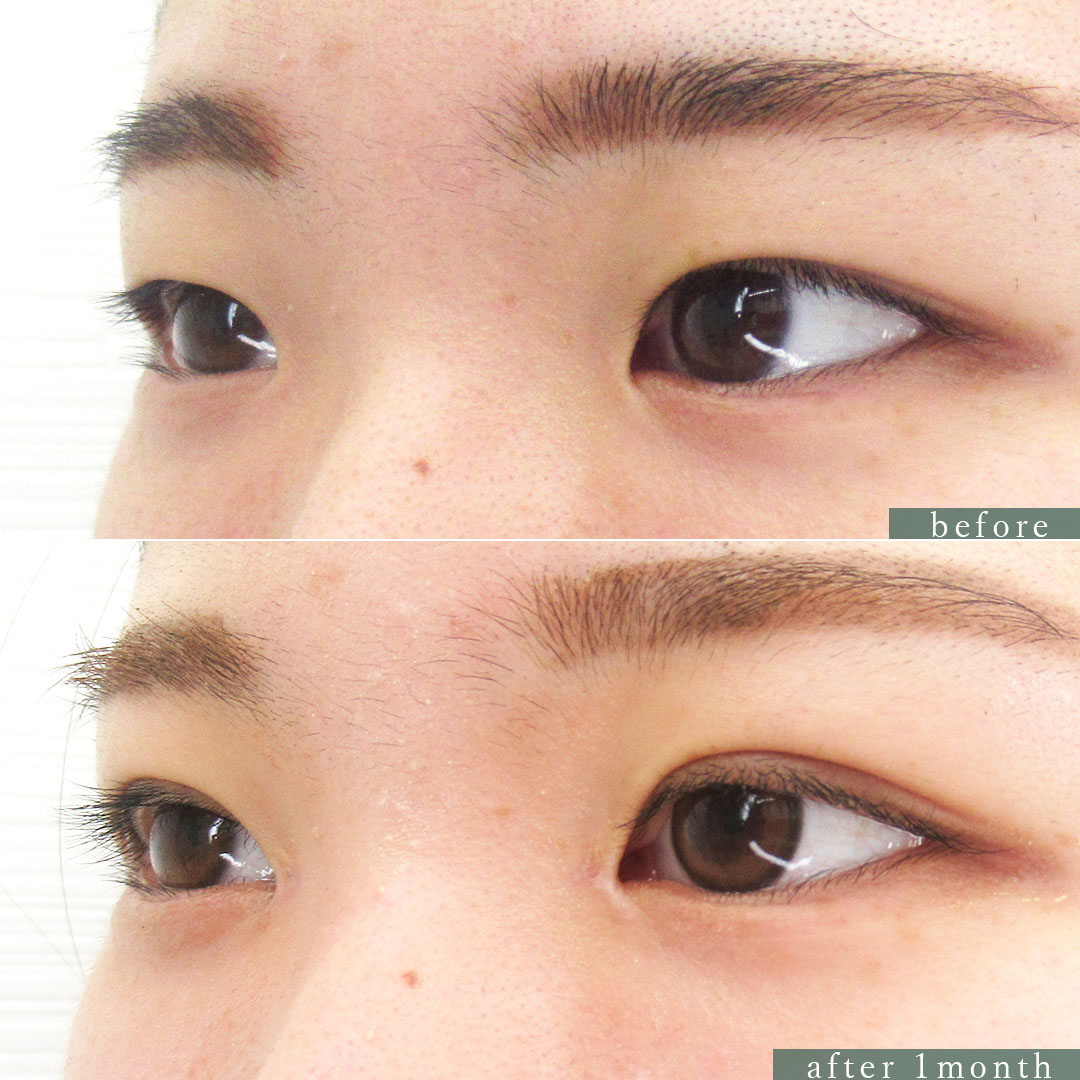 二重埋没法/目頭切開術の症例写真 施術前後 