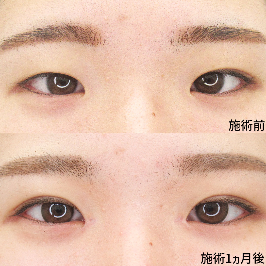 二重埋没法/目頭切開術の症例写真 施術前後 
