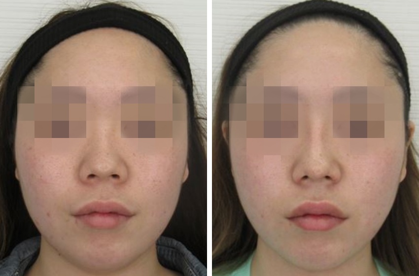 お鼻の施術を組み合わせて全体的なお鼻の改善