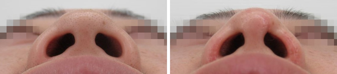 隆鼻術（プロテーゼ・自家組織）/鼻孔縁挙上術/鼻尖4Dノーズの症例写真 施術前後 1ヵ月後
