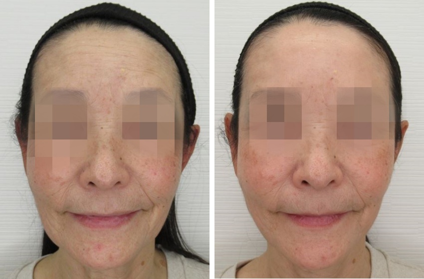 40代以降の本気の悩み「くぼみ」を糸リフトで改善