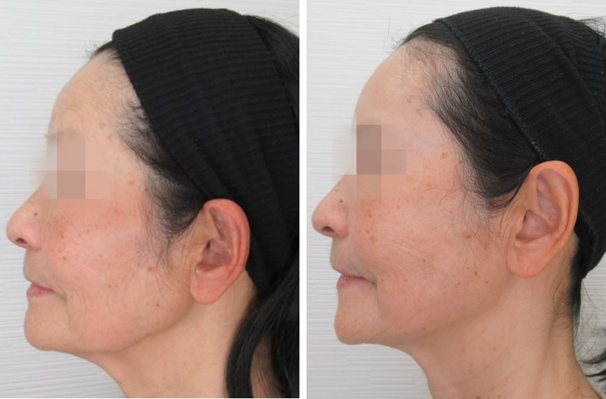 おでこボトックス注射の症例写真 施術前後 1ヵ月後