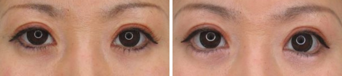 グラマラスライン（タレ目形成）の症例写真 施術前後 1ヵ月後