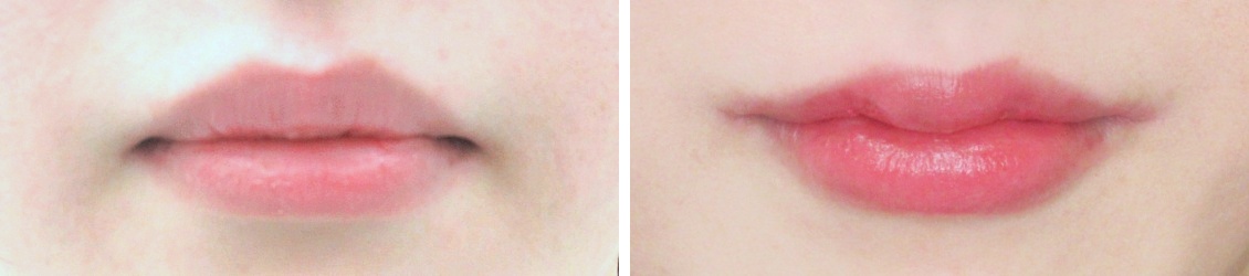 M字リップ形成と口角リフトで明るい印象に