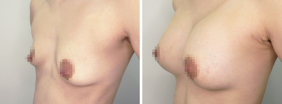 人工乳腺バッグで綺麗なバストに