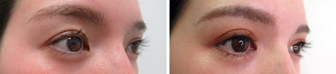 目頭切開術/グラマラスライン（タレ目形成）/二重切開（全切開法）の症例写真 施術前後 1ヶ月