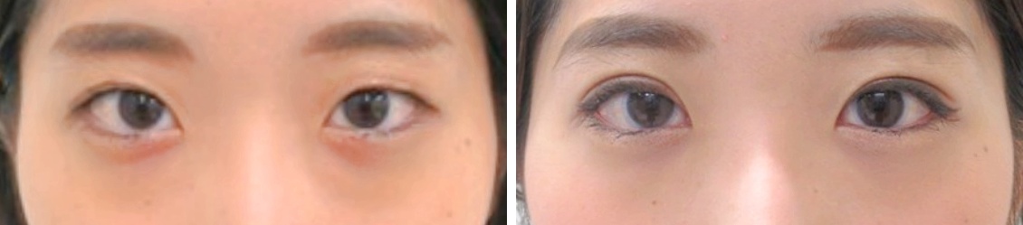 一重で悩んでいるなら埋没法