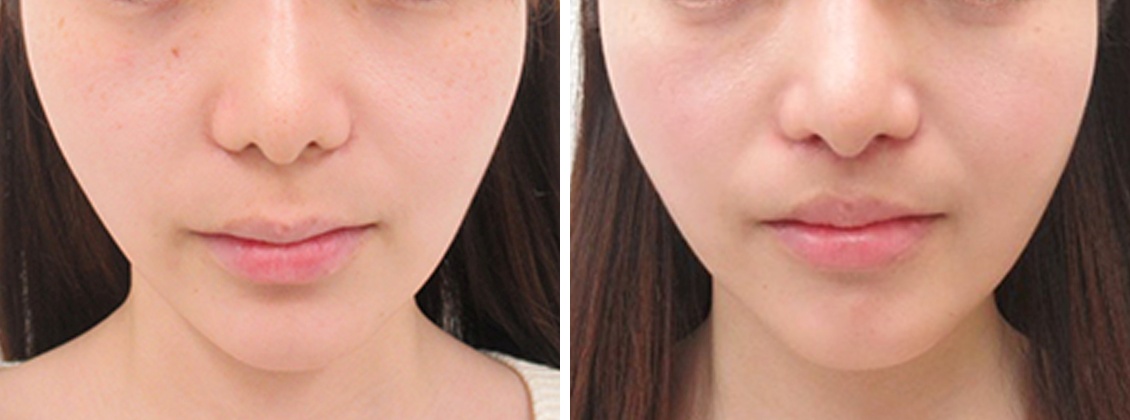 人中短縮術でより整ったお顔に