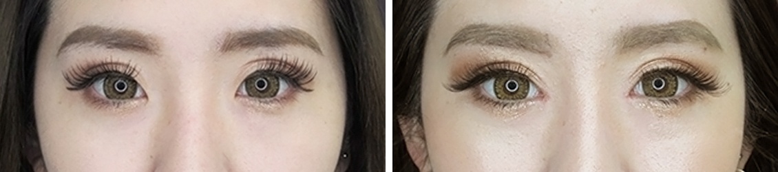 目頭切開術で蒙古ひだをなくし より大きな目元に