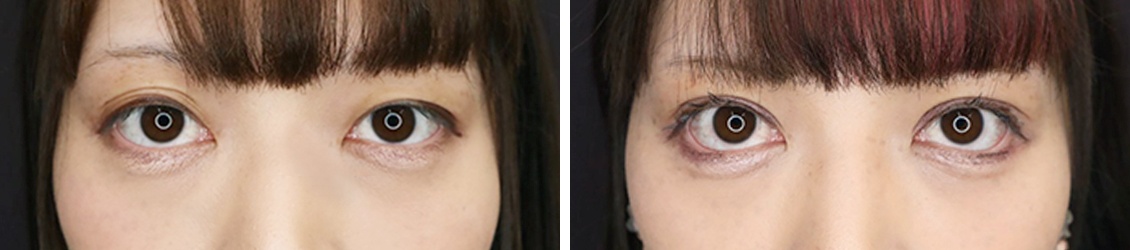 二重全切開とグラマラスラインで理想の目元