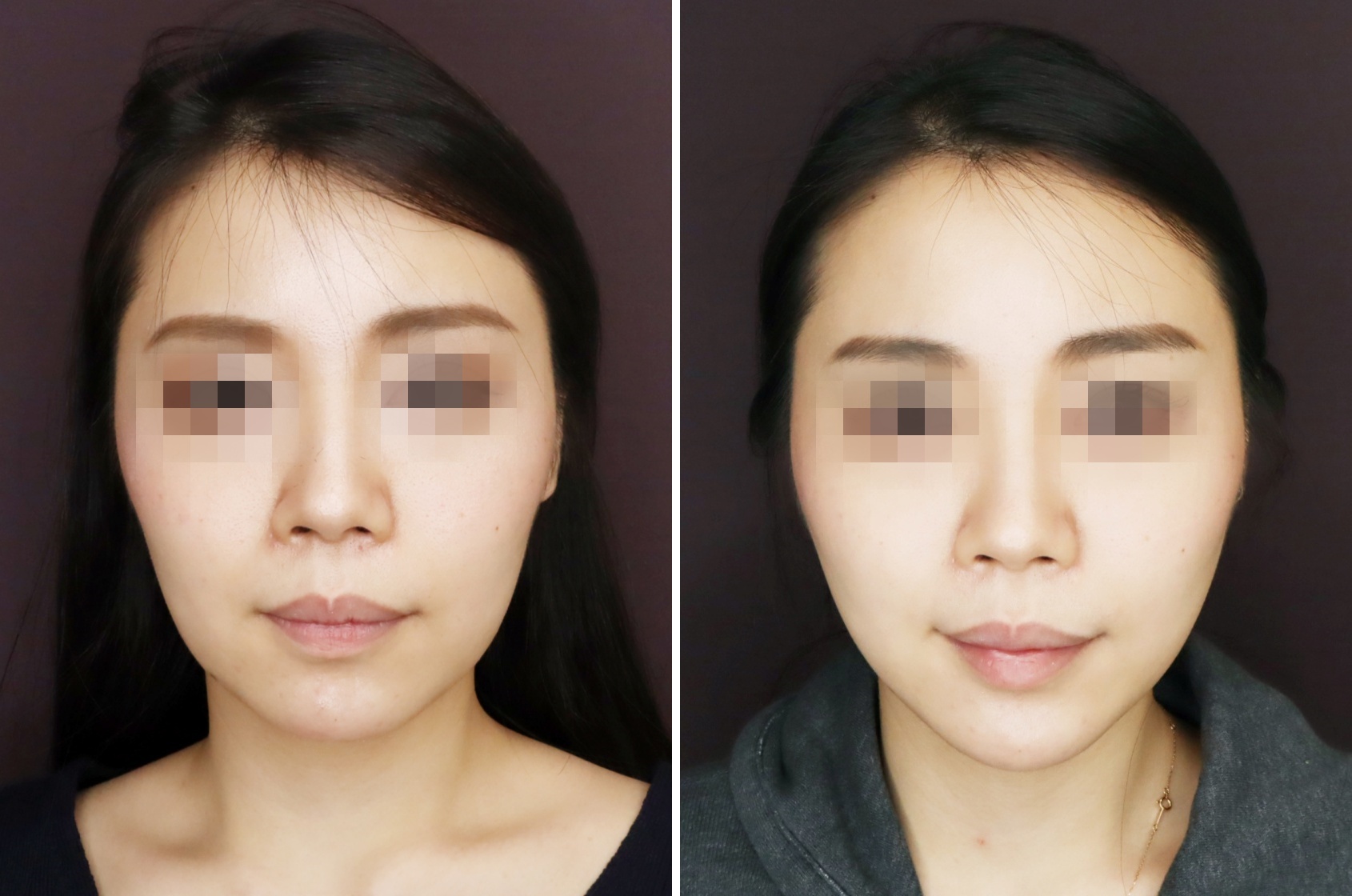 キツネラインでシャープな小顔