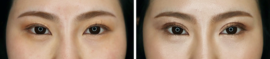 お手軽にかわいくなりたいなら埋没法