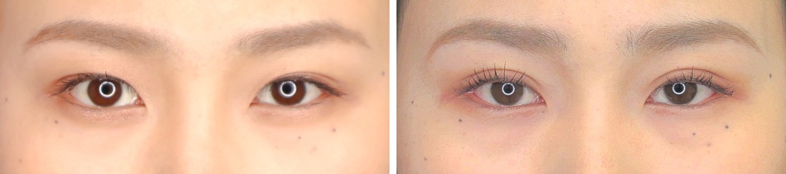 二重埋没法の症例写真 施術前後 1ヵ月