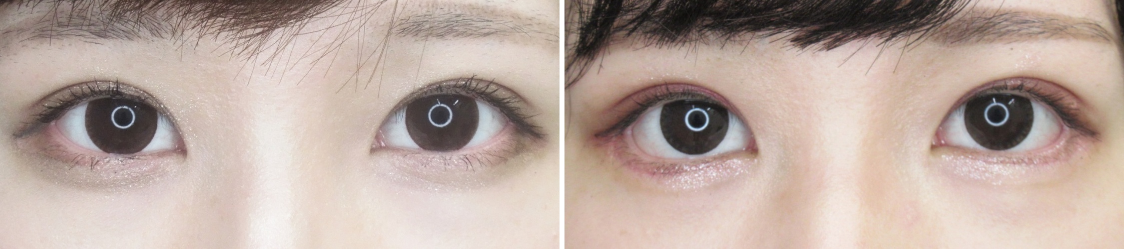 目尻靭帯移動とグラマラスラインでタレ目形成