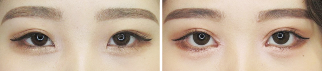 目頭切開とグラマラスラインで目の大きさが一回りUP!!