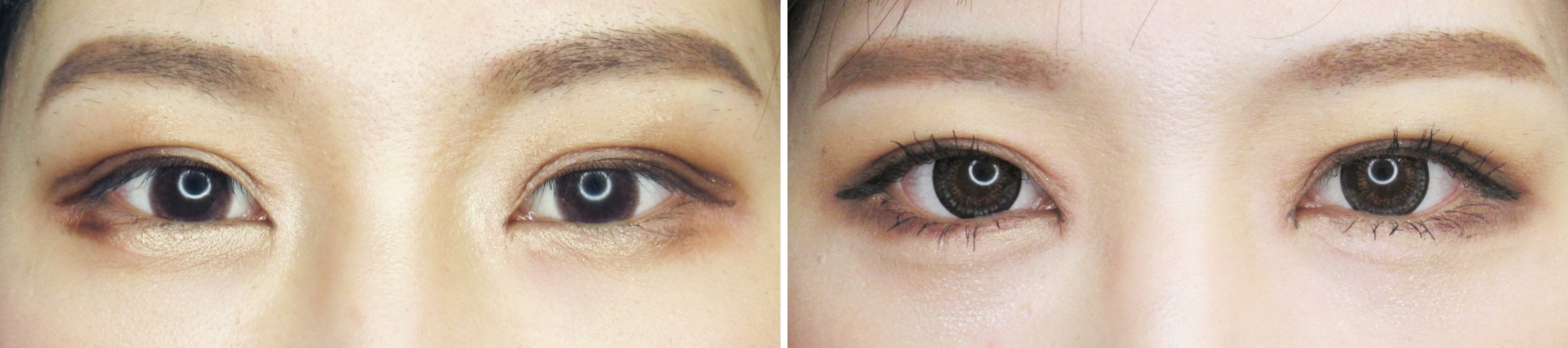 グラマラスラインと目尻靱帯移動術で大きくキリっとした目元