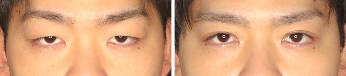 眼瞼下垂と二重全切開で新しい自分