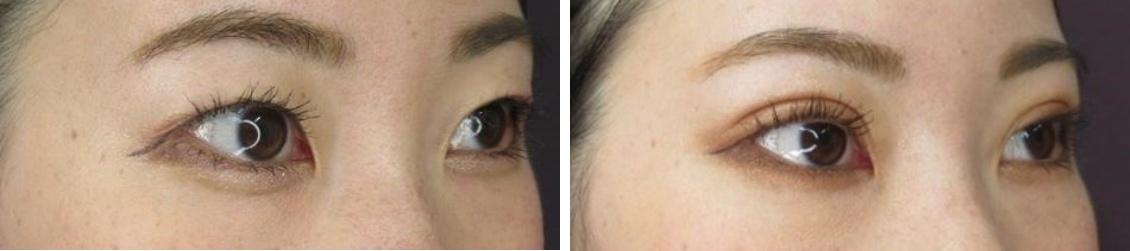 二重埋没法の症例写真 施術前後 1ヵ月後