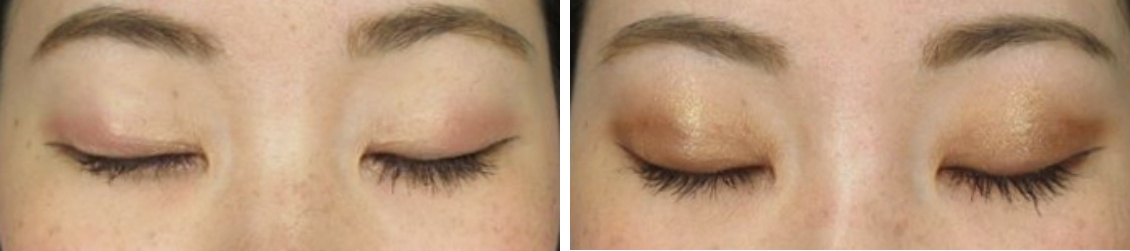 二重埋没法の症例写真 施術前後 1ヵ月後