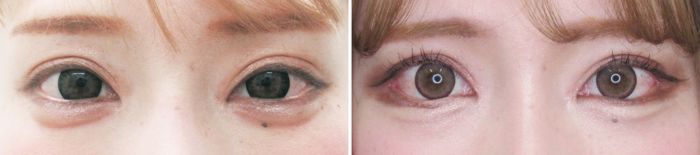 グラマラスライン（タレ目形成）/目尻切開術の症例写真 施術前後 1ヵ月