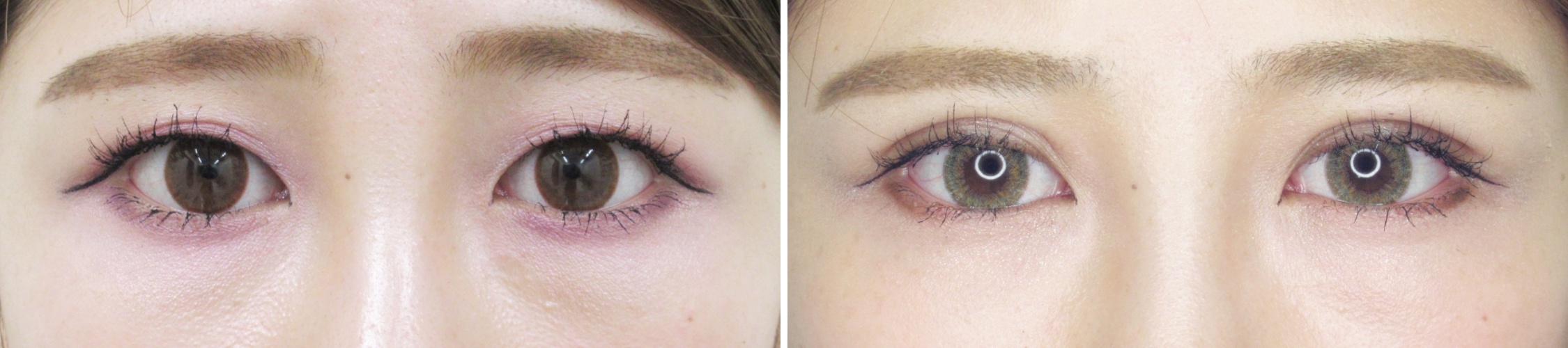 もともと二重の方も！埋没法でさらにパッチリお目元に