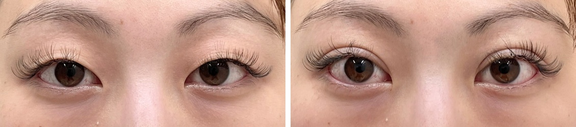 クイックコスメリングで直後から腫れを最小限に