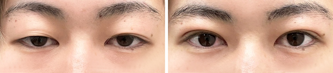 クイックコスメリングで限りなく天然に近い末広二重