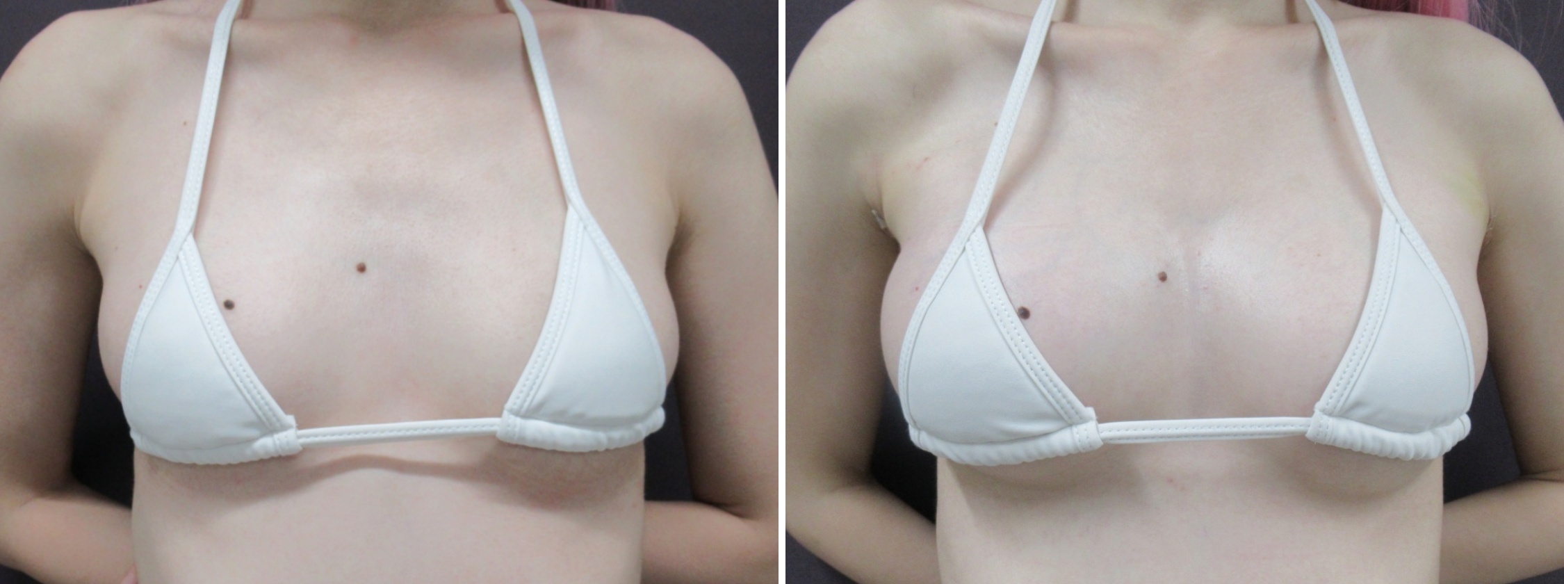 ヒアルロン酸注入豊胸術（グラビアバスト）の症例写真 施術前後 1週間
