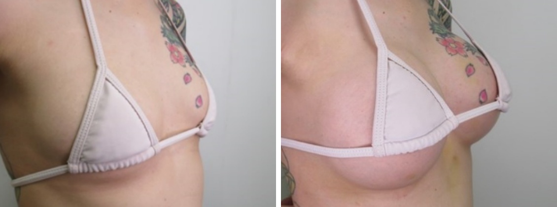 シリコンバッグ豊胸（人工乳腺バッグ）の症例写真 施術前後 1週間