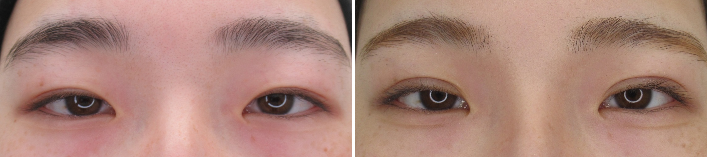 ダウンタイムの少ない埋没法でキレイな二重に