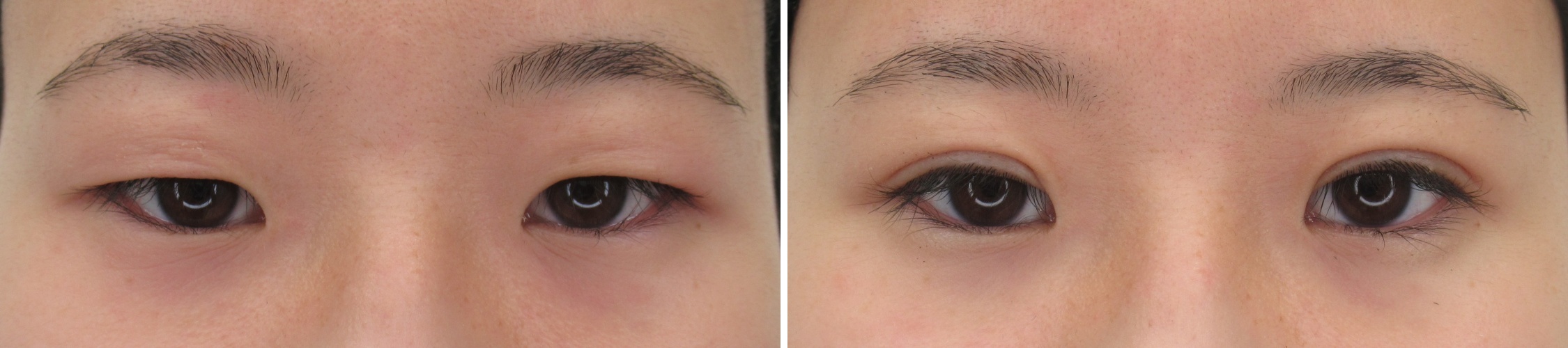 二重埋没法の症例写真 施術前後 １週間