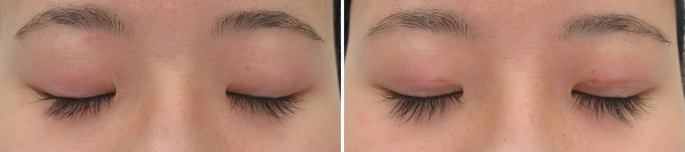 二重埋没法の症例写真 施術前後 １週間