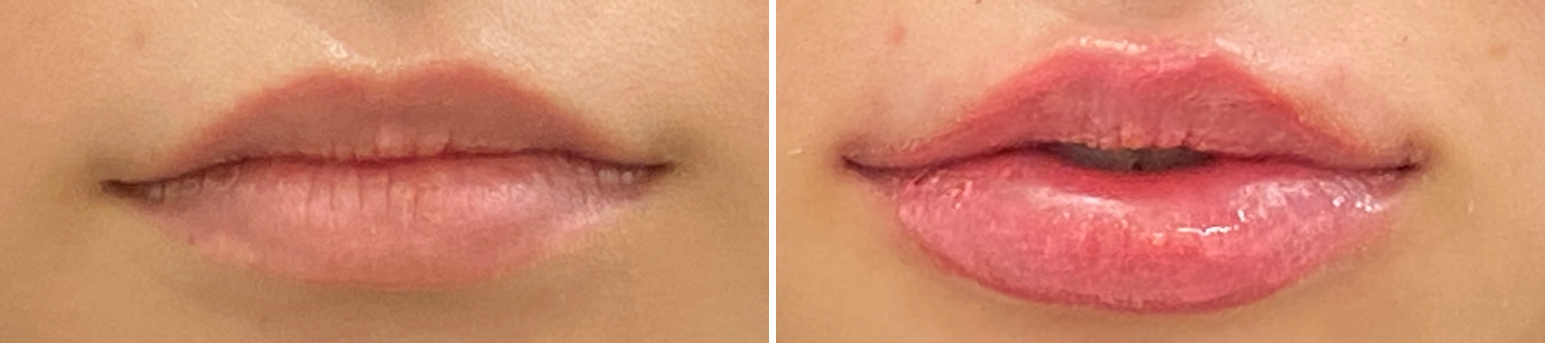 ヒアルロン酸でセクシーな唇に