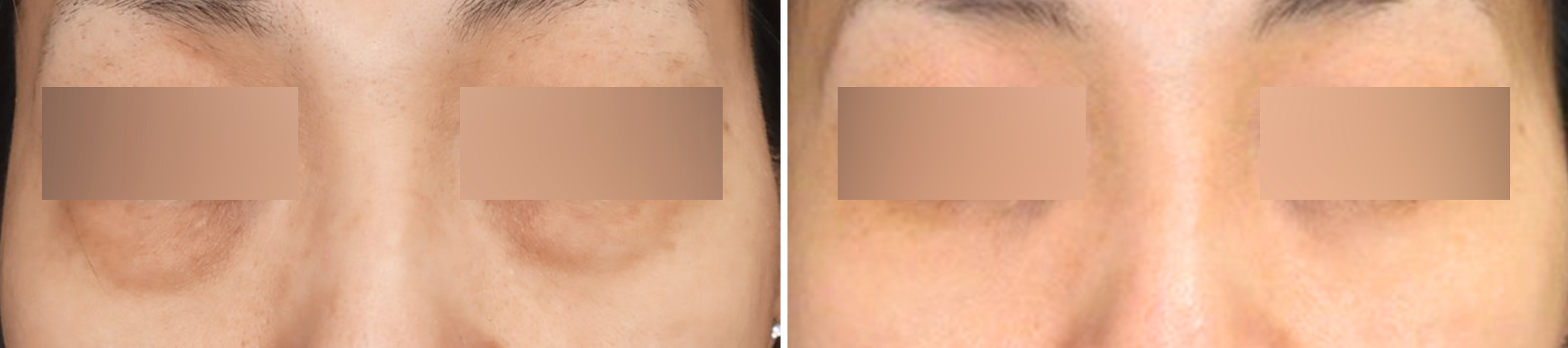 下眼瞼脱脂術で若々しい目元に