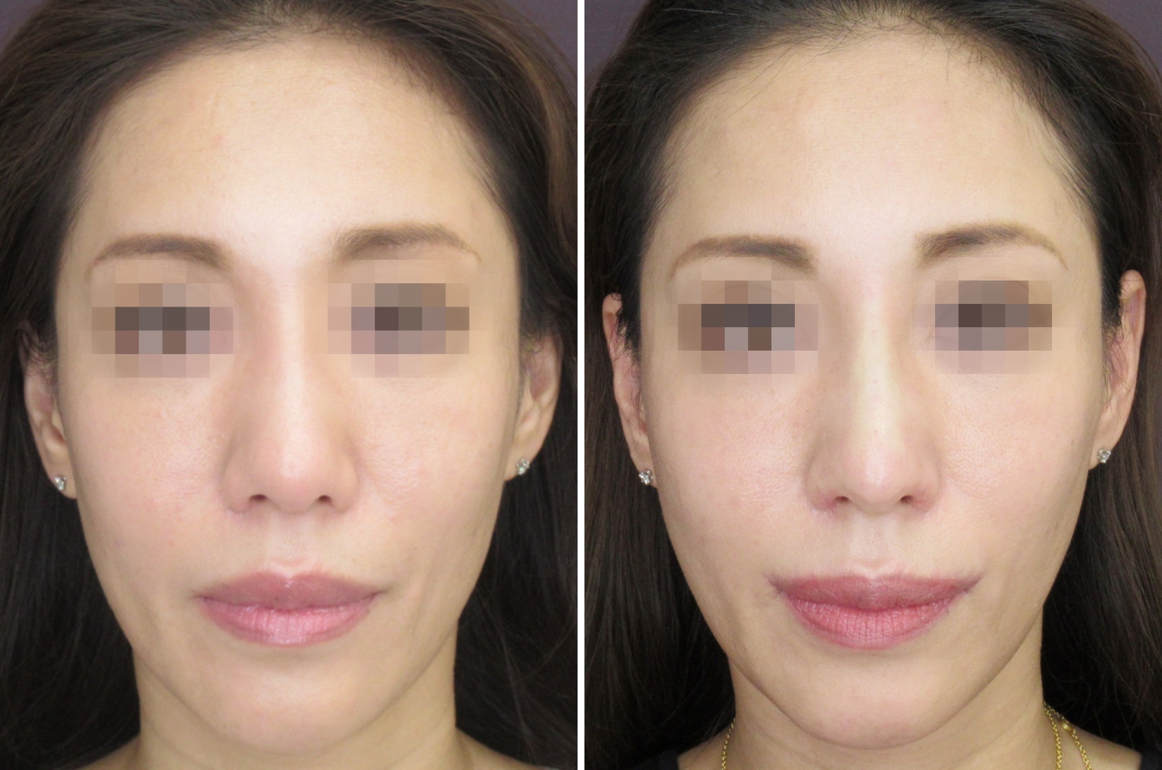 外側人中短縮術と口角リフトで下がった口角を自然にUP