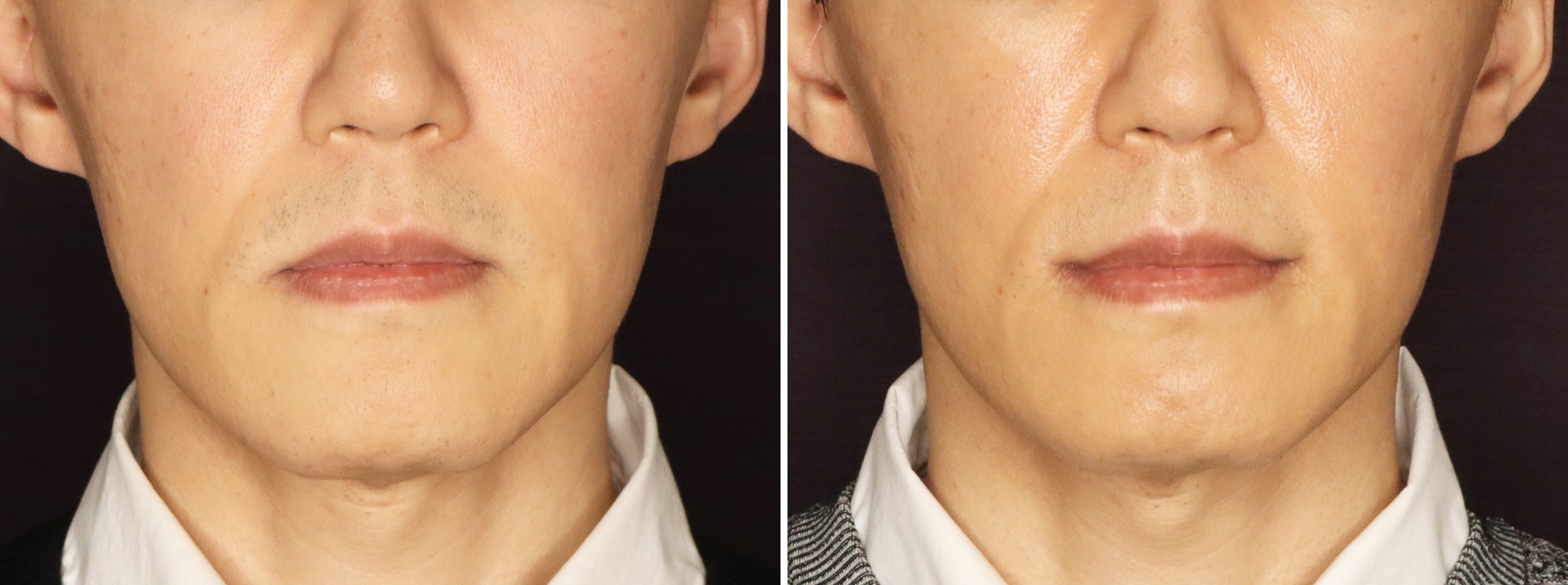 口角リフトでいつでも明るい印象