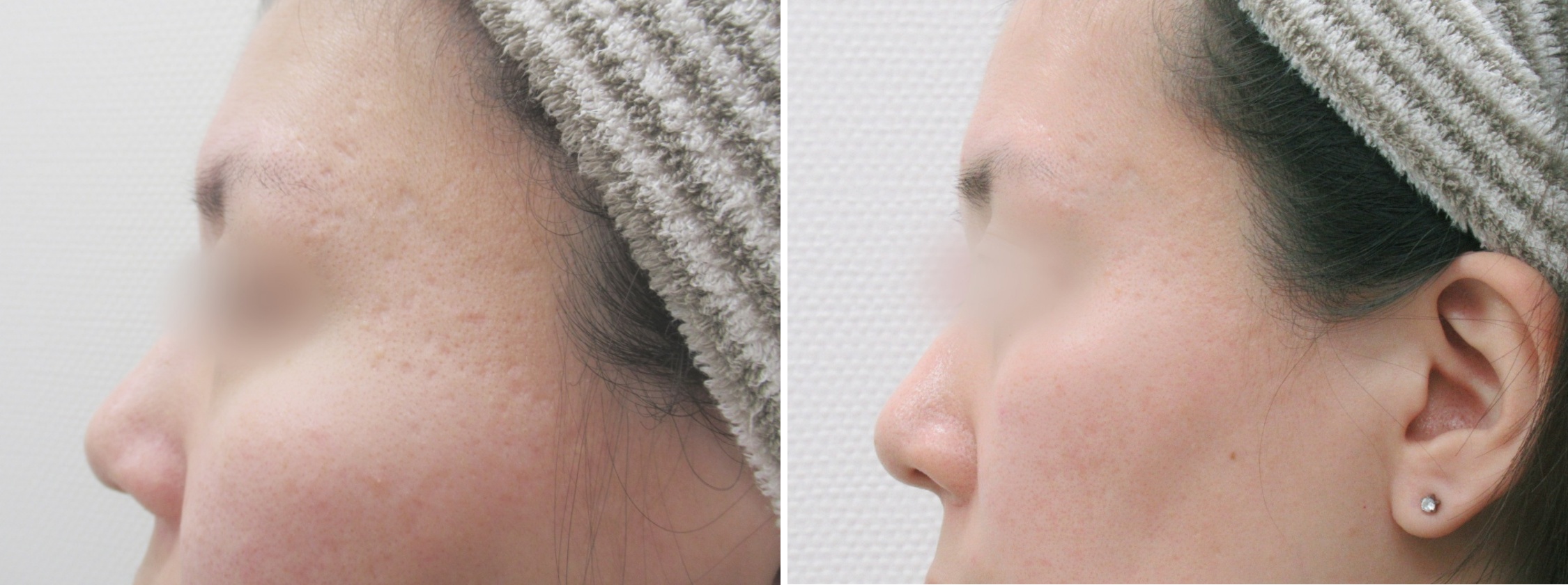 ホームケアでは難しいクレーター肌の改善にはヴァンパイアフェイシャル