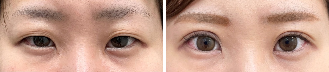 上眼瞼切開術と眼瞼下垂でもかわいい二重はつくれます