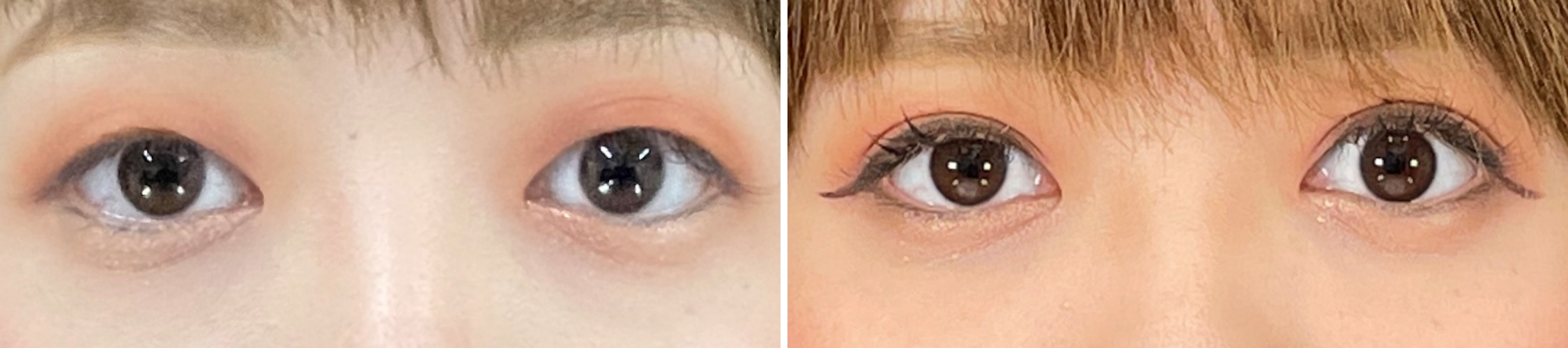 症例写真 ダウンタイム 目の開きを良くして印象に残るeyes Taクリニックグループ 美容整形 美容外科 全国展開中