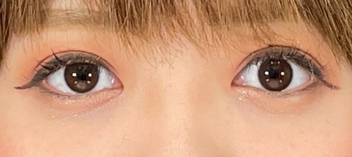 症例写真 ダウンタイム 目の開きを良くして印象に残るeyes Taクリニック 美容整形 美容外科 新宿 銀座 横浜 大阪 福岡 川越 高崎 Taクリニック 美容整形 美容外科