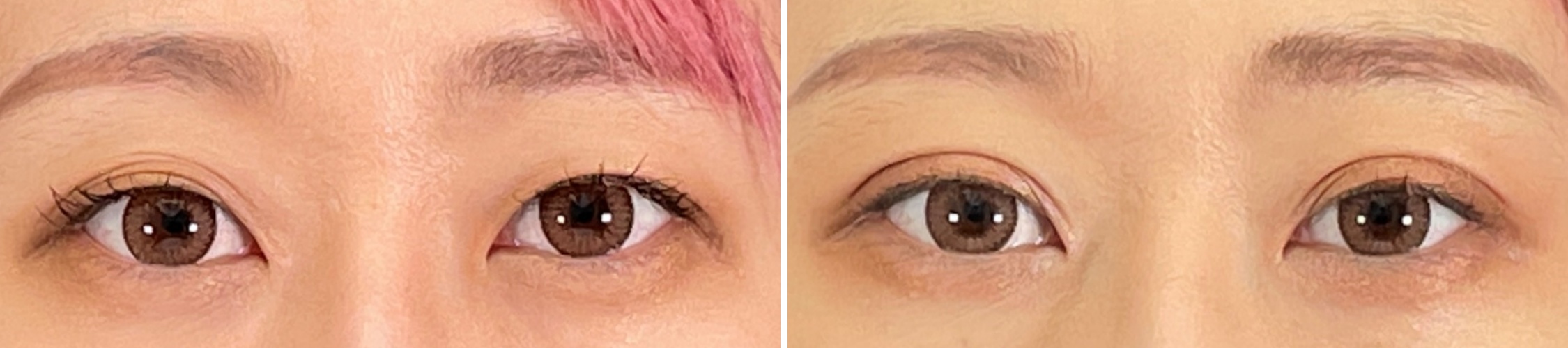 二重埋没法で優しい印象の目元に