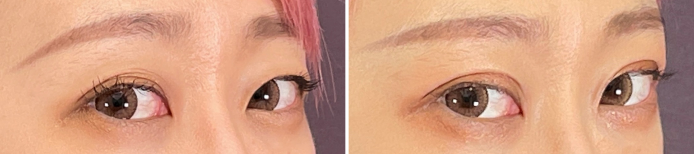 二重埋没法の症例写真 施術前後 1週間後