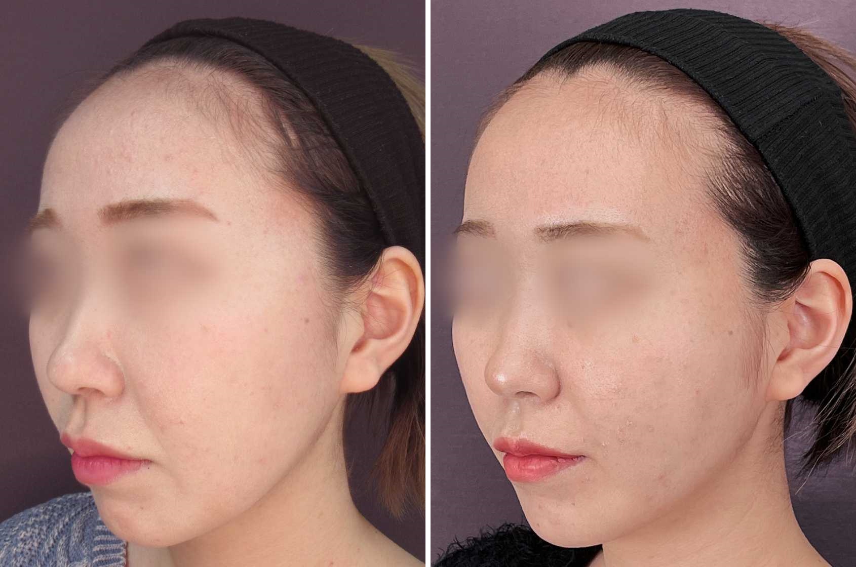 ほうれい線のヒアルロン酸注射/顎のヒアルロン酸注射/TAC式 ツヤ肌コラーゲンリフト®の症例写真 施術前後 3ヵ月後