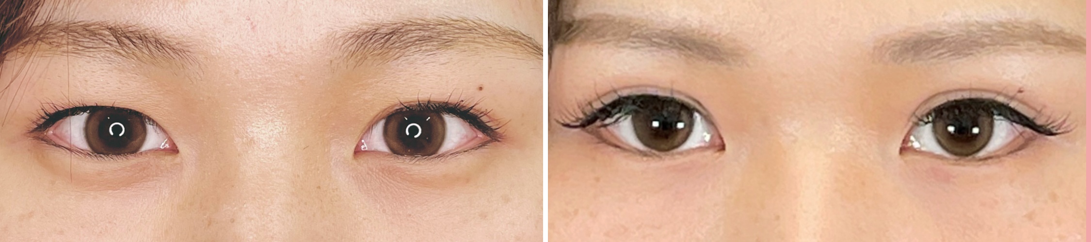 埋没法でナチュラルかわいい目元に変わる