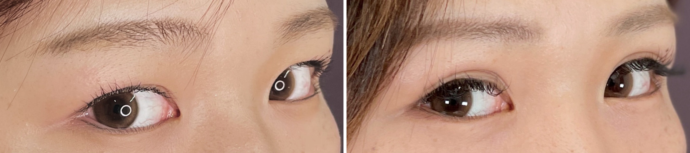 二重埋没法の症例写真 施術前後 2ヵ月後