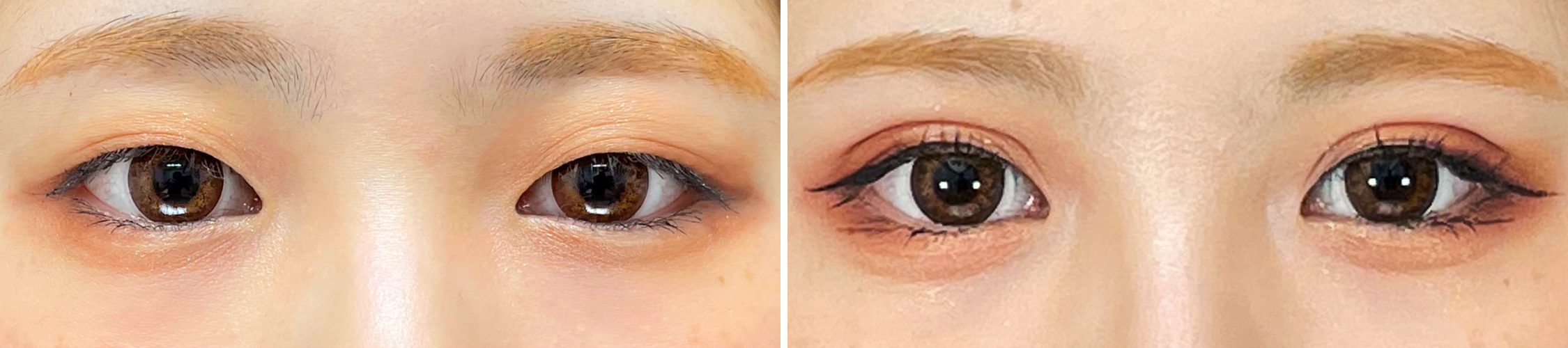 二重埋没法の症例写真 施術前後 1週間後