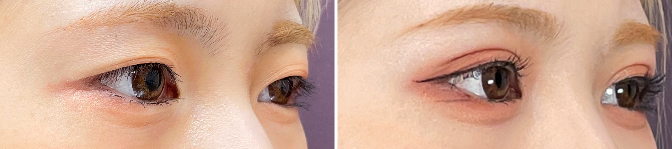 二重埋没法の症例写真 施術前後 1週間後