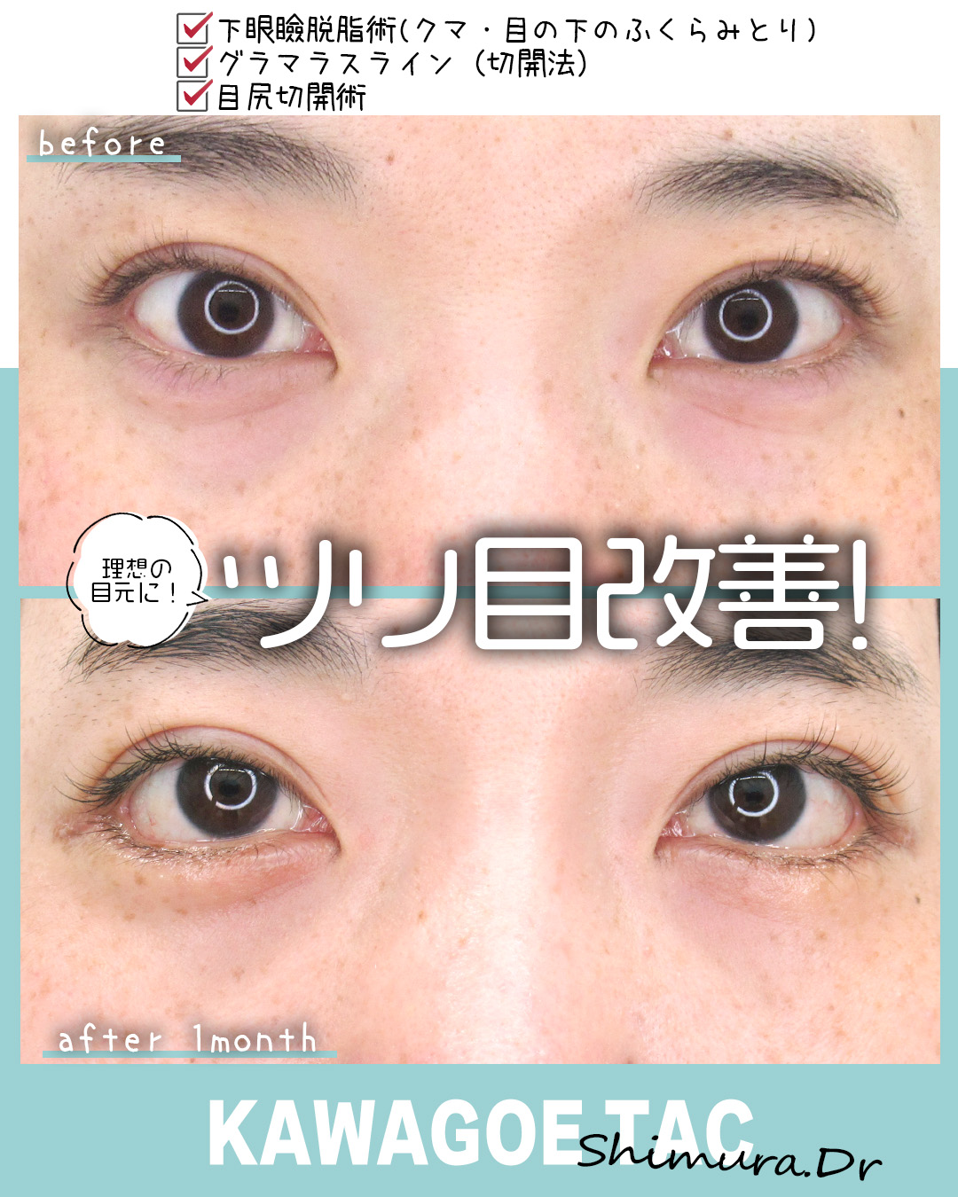 グラマラスライン（タレ目形成）/目尻靭帯移動術の症例写真 施術前後 