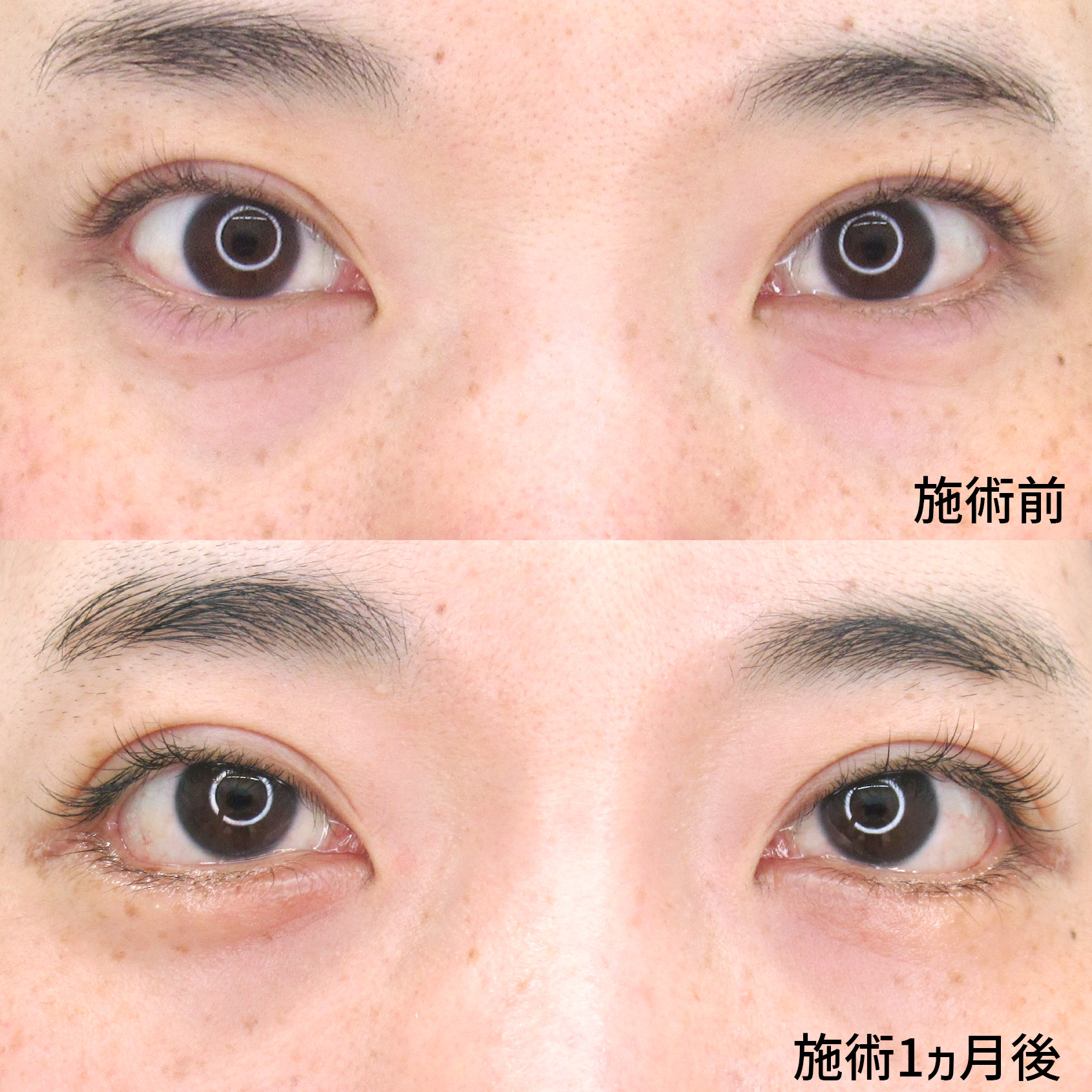 グラマラスライン（タレ目形成）/目尻靭帯移動術の症例写真 施術前後 